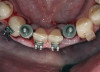 Fig 7. Maxillary denture flange aids in lip support.