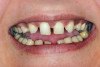 Fig 8. Flangeless denture tried-in showing importance of lip support in this case; facial view (Fig 8) and profile view (Fig 9).