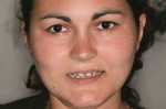 Figure 1 A guarded smile could not hide the irregular spacing that complicates the replacement of missing teeth.