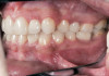 Fig 10. Transition line can be seen between maxillary implant-supported prosthesis and residual soft-tissue crest.