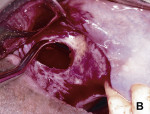 Figure 1  Using a lateral window approach to access the maxillary sinus, the Schneiderian membrane was elevated to create space for graft material.