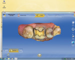 Figure 2 Inlay preparation on a molar, tooth No. 3, with a 1.5-mm reduction in the central groove, 1.5-mm isthmus width, proximal box extension, and straight axial walls exiting gracefully, with rounded internal, 6- to 8-degree divergence, and tissue retraction with a cord.