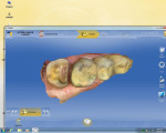 Figure 6 Complete cuspal reduction on a molar, tooth No. 15, with no axial reduction. The mesial margin of the tooth was properly exposed with a laser because it was deep and the tissue was hemorrhaging. The gingival box helps achieve a positive keyway.