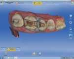 Figure 4 Inlay preparations on teeth Nos. 13 and 14. Note the 1.5-mm reduction in the central groove, proximal box extension, straight axial walls exiting gracefully, with rounded internal, 6- to 8-degree divergence, and tissue retraction with a cord, as well as the mesial wall of the second molar, which is completely imaged.