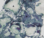 Figure 3  Histological analysis of bone biopsies revealed bone content: occurrence of graft particles (A), newly formed osteoid (B), and mineralized bone (C). Goldner’s staining, representative sections of weeks 25 (Fig 3), 27 (Fig 4), 30 (Fig 5),