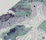 Figure 4  Histological analysis of bone biopsies revealed bone content: occurrence of graft particles (A), newly formed osteoid (B), and mineralized bone (C). Goldner’s staining, representative sections of weeks 25 (Fig 3), 27 (Fig 4), 30 (Fig 5),