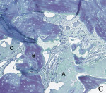 Figure 5  Histological analysis of bone biopsies revealed bone content: occurrence of graft particles (A), newly formed osteoid (B), and mineralized bone (C). Goldner’s staining, representative sections of weeks 25 (Fig 3), 27 (Fig 4), 30 (Fig 5),