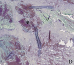 Figure 6  Histological analysis of bone biopsies revealed bone content: occurrence of graft particles (A), newly formed osteoid (B), and mineralized bone (C). Goldner’s staining, representative sections of weeks 25 (Fig 3), 27 (Fig 4), 30 (Fig 5),