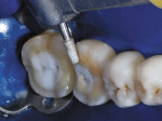 Figure 3  Onlay margins being re-prepared with a fine-diamond bur following IDS to remove resin along the enamel margins.