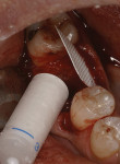 Figure 2  Calcium sulfate material being inserted into the surgical site from the applicator; dPTFE barrier on lingual of the socket.