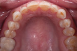 Occlusal view, upper arch, pre-treatment.