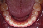 Occlusal view, lower arch, pre-treatment.