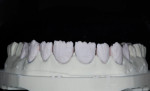 Transparent dentin is thinly layed on the gingival and middle thirds of the teeth. Opacious dentin is thinly layed toward incisal structures to avoid a visible line between natural tooth structure and the incisal of the veneer.