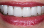 This patient requested bleached teeth. She was treated with PFM crowns on teeth Nos. 4-13. Clinical dentistry and photography courtesy Dr. J. Becker.