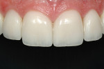 Some patients envision a more natural, healthy, or age-appropriate outcome for their restorative treatment. Clinical dentistry and photography courtesy Dr. J. Files.