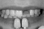Shade communication pictures, including a black and white imagery for interpreting value, is essential for anterior cases. Patient is having tooth No. 9 restored with an implant and a zirconia abutment with a zirconia crown. Photography courtesy Dr. J. Campo.