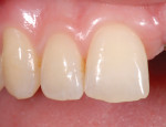 Shade communication pictures, including a black and white imagery for interpreting value, is essential for anterior cases. Patient is having tooth No. 9 restored with an implant and a zirconia abutment with a zirconia crown. Photography courtesy Dr. J. Campo.