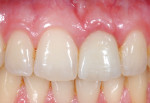 Implant restoration on tooth No. 9 after seating. Photography courtesy Dr. J. Camp