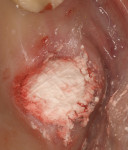 Figure 5  Biphasic calcium phosphate completely filled socket to within 1 mm of gingival margin.