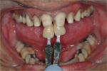 This patient presented for treatment wanting to change the appearance of his front teeth, which were severely discolored. The treatment plan comprised 10 veneers on the maxilla and 6 mandibular anterior veneers. The preparations were adapted to mask the horizon- tal banding. Clinical dentistry and photography courtesy Dr. J. Files.