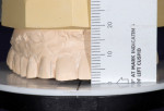 The photographs are used firstly to verify the accuracy of the cast on the articulator, and then to interpret ideal incisal edge position. The current tooth length can then be evaluated to judge where to add wax for ideal tooth proportion and display in the patient’s smile. Clinical photography courtesy Dr. D. Jayne.