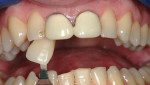 All-ceramic crowns were made to replace defective PFM restorations on teeth Nos. 8 and 9; direct bonding on tooth No. 7 completed the treatment. Clinical dentistry and photographs courtesy Dr. J. Files.