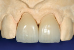 All-ceramic crowns were made to replace defective PFM restorations on teeth Nos. 8 and 9; direct bonding on tooth No. 7 completed the treatment. Clinical dentistry and photographs courtesy Dr. J. Files.