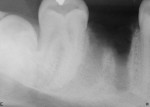 Figure 8  Radiograph showing significant bone loss after extraction of tooth No. 30. Clinical evaluation revealed loss of buccal plate.
