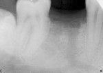 Figure 10  Four months after extraction and graft, radiographic evaluation showing full bone reformation to the height of the proximal alveolar crests.