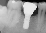 Figure 12  Four months after cementation of the final crown on the one-stage implant, the crestal bone level remains stable.
