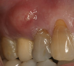 Figure 13  A large facial swelling around the infected upper right premolar tooth