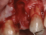 Figure 14  After flap elevation and debridement, a large extraction socket defect reveals no facial plate of bone.