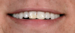 Figure 1 The patient presented with old, worn, chipped composite restorations undermined with caries on teeth No. 8 and No. 9.