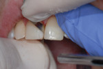 Figure 3 Using a superfine diamond finishing strip (Cosmedent’s FlexiDiamond Strips). Running a wide or narrow strip once or twice through the contact will smooth the contact area.