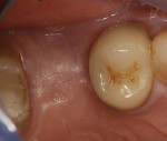Figure 16  Prior to uncovering, this occlusal view shows ridge width preserved and keratinized tissue augmented by the grafting method used.