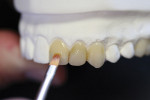 Figure 15 Gingival warmth and down toning are added with a sable hair brush mixture of ochre and clear.