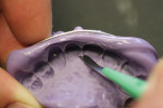 Figure 3 The lingual interproximal fins are removed to give more bulk and strength to the connector.