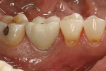 Figure 18  Three-year clinical view of patient 2 (shown in Fig 8 through Fig 12) demonstrates stability of the gingival tissues.