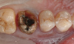Figure 2 The crown was sectioned and removed, with existing caries and evident leakage noted.