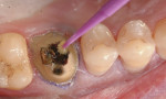 Figure 5 The tooth was treated with adhesive using a self-etch mode.