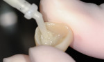 Figure 6 Cement was dispensed through the auto-mix syringe bent tip into the lumen of the crown.