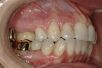 Figure 5  Right lateral view before treatment. Note the coronal gingival position and bony exostosis of tooth No. 3, and the cross-bite of teeth Nos. 3 and 30.