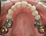 Figure 6  Maxillary arch before treatment showing holes worn in the gold crowns of teeth Nos. 2 and 15 as well as pre-existing restorations.