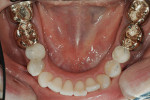 Figure 7  Mandibular arch before treatment showing moderate wear on tooth No. 31 and early chemical erosion on teeth Nos. 23 through 26.