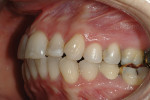 Figure 8  Left lateral view before treatment showing cross-bite of teeth Nos. 14 and 19 as well as buccal tooth decay on No. 19.