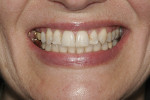 Figure 11  Cross-bite correction and remaining uneven tissue levels are shown following orthodontic treatment.