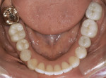Figure 17  Posttreatment mandibular arch photograph shows the final restorations.