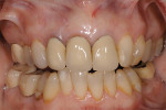 Figure 1  Pretreatment condition of patient presenting for removal of existing metal-ceramic crowns on teeth Nos. 7 through 9 due to caries and open margins.