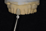 Figure 2  Selection of an appropriate-sized polycarbonate crown corresponding to tooth size from the patient’s diagnostic cast.