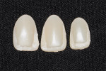 Figure 4  Lingual surfaces of the severed polycarbonate facings. Note the proximal surfaces are preserved.